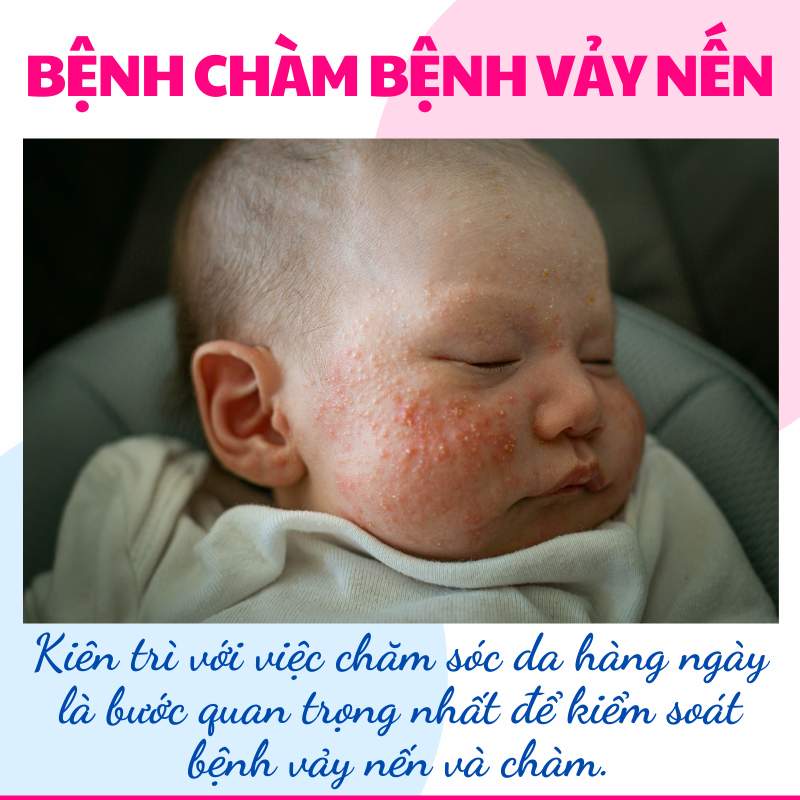 Bệnh vẩy nến khi cho bé bú